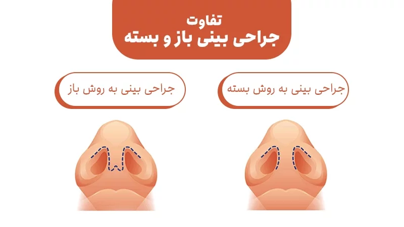 فرق بین جراحی باز و بسته