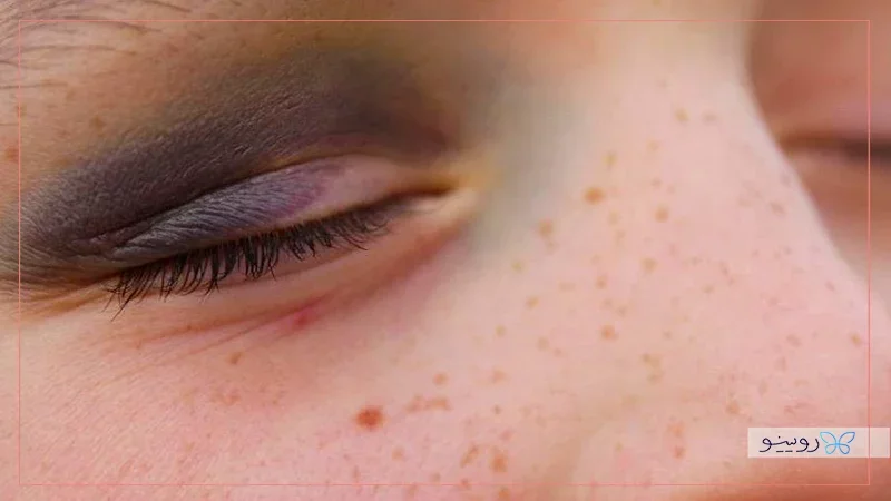 مراحل رفع کبودی و ورم چشم بعد از عمل بینی