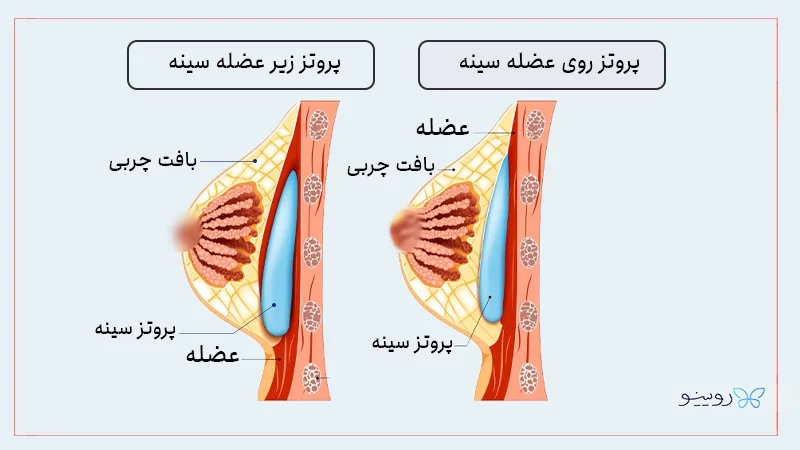تفاوت پروتز سینه زیر عضله با روی عضله1