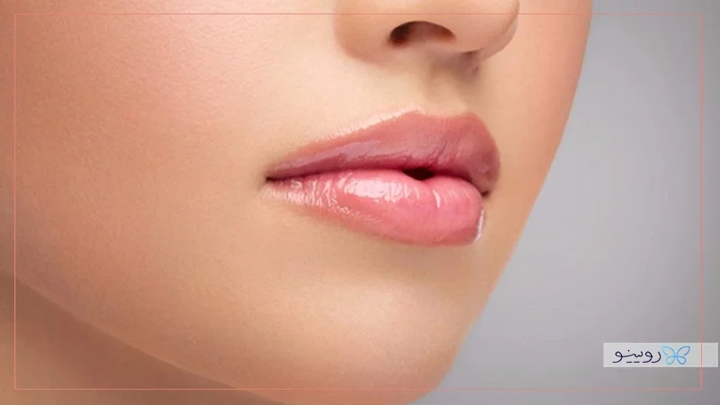 فیلر لب مدل شرقی