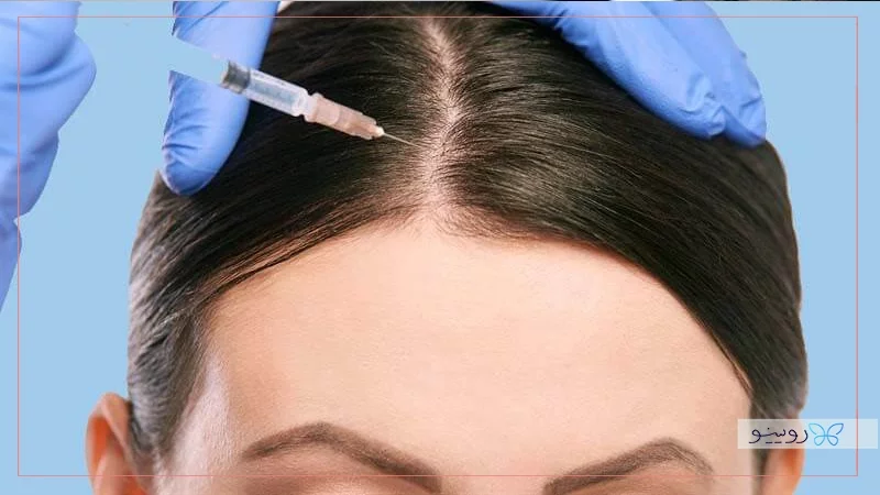 تأثیرگذاری مزوتراپی بر روی مو