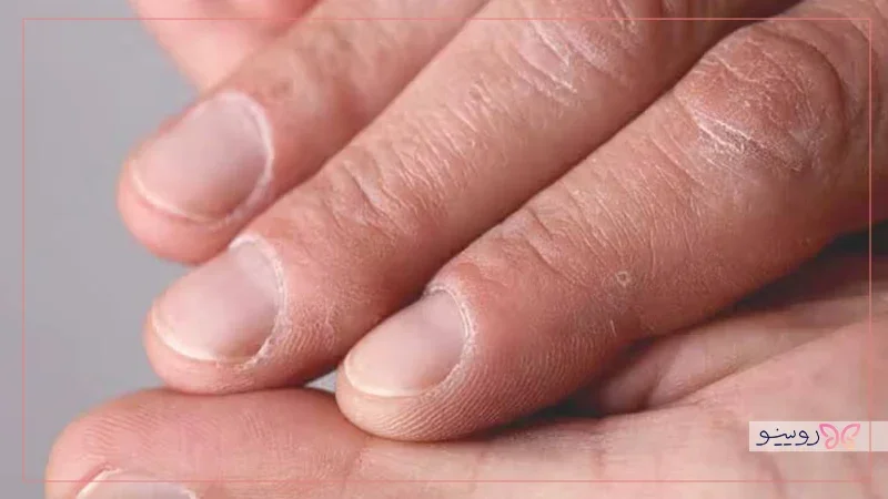 علت شکنندگی و پوسته شدن ناخن