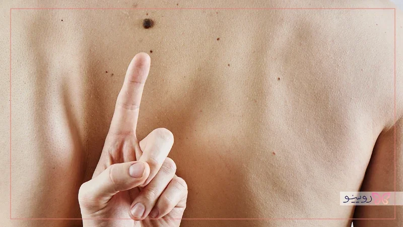 از بین بردن خال صورت در یک روز در خانه