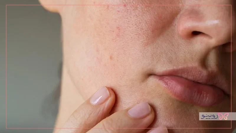ماسک خانگی برای منافذ باز پوست