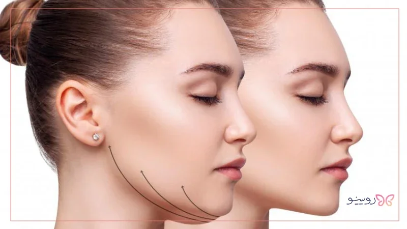 ماندگارترین روش چاقی صورت