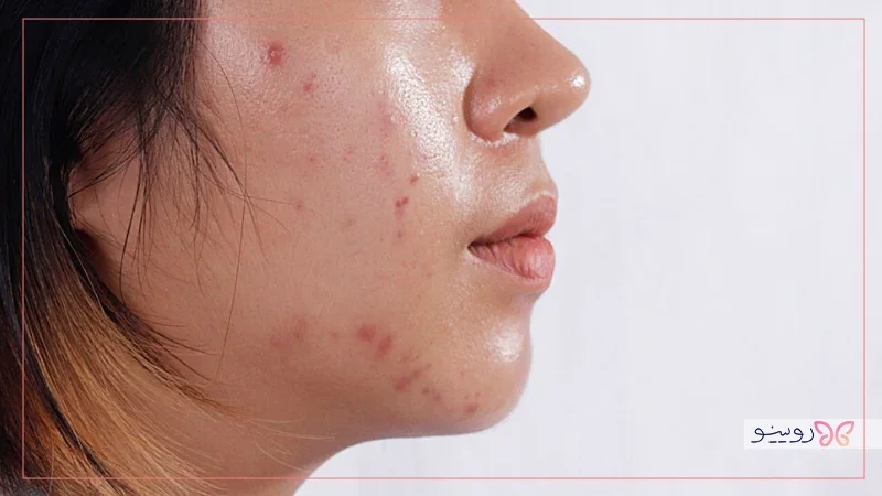 پاکسازی پوست چرب و جوش دار در منزل