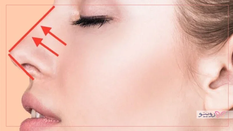 جراحی بزرگ کردن بینی