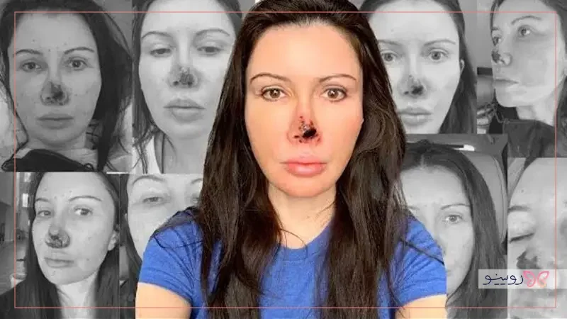 نکروز بینی؛ یکی از جدی‌ترین خطرات در زیبایی صورت