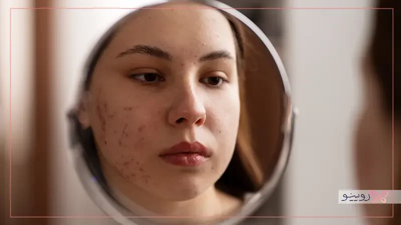 پیشگیری از دانه‌ های قرمز روی پوست