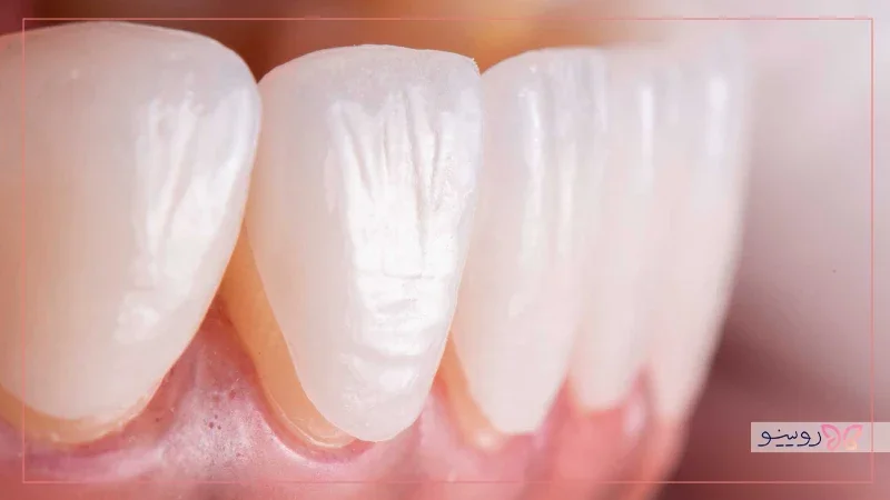 لمینت دندان چیست و چه کاربردی دارد؟