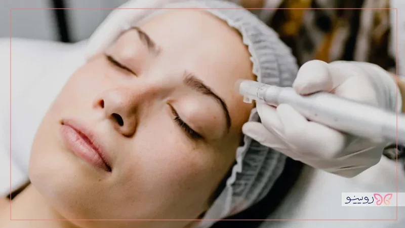مزایای مزونیدلینگ برای پوست