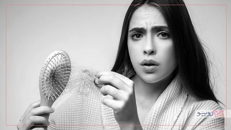 درمان ریزش موی ارثی و هورمونی