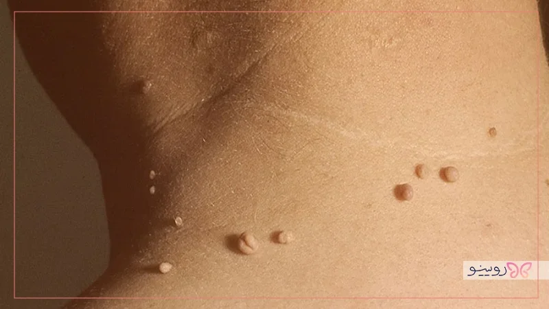 منگولههای پوستی یا منگولههای گوشتی