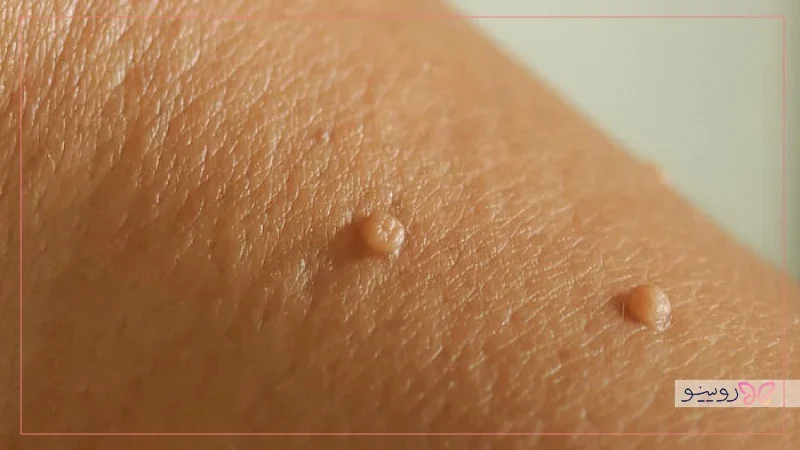 بند انداختن (لیگاتور)