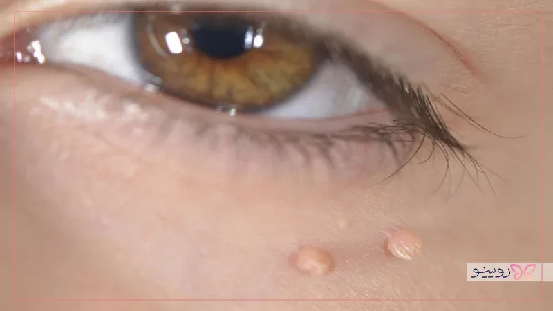 نکات مهم در پیشگیری از منگولههای پوستی