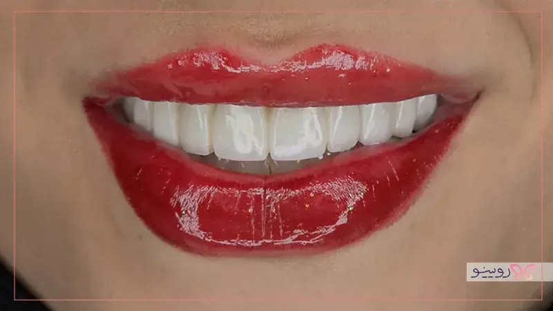 مراحل گذاشتن لمینت دندان