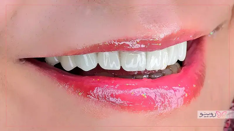 انواع لمینت دندان کدامند؟