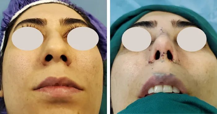 before & after photo of عمل زیبایی بینی