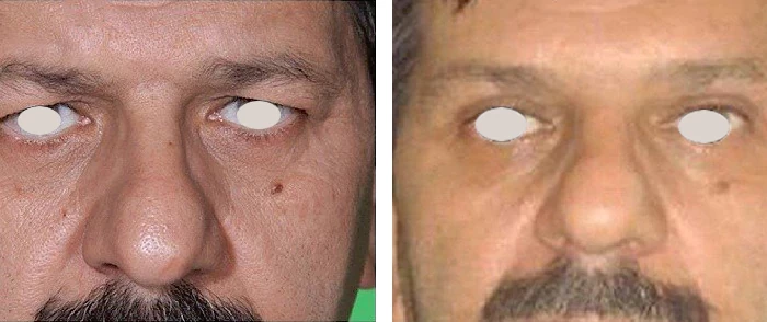 before & after photo of جراحی لیفت مستقیم ابرو