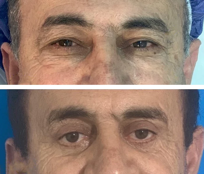 before & after photo of بلفاروپلاستی (جراحی پلک)