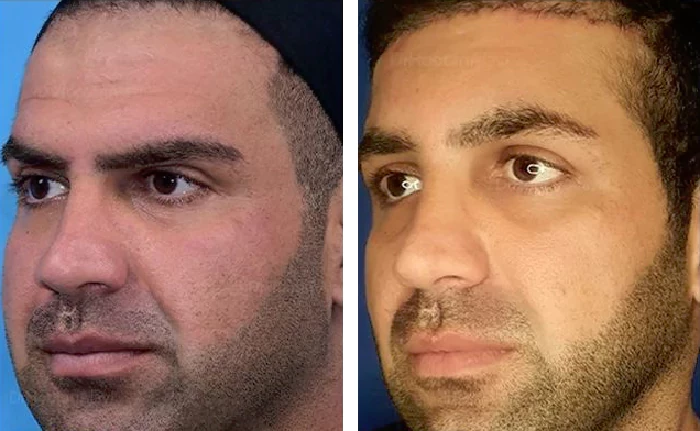 before & after photo of جراحی لیفت مستقیم ابرو