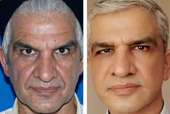 before & after photo of جراحی لیفت گردن