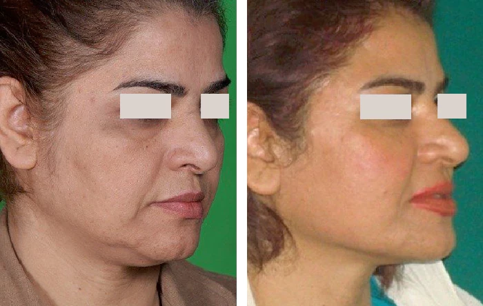 before & after photo of جراحی لیفت صورت