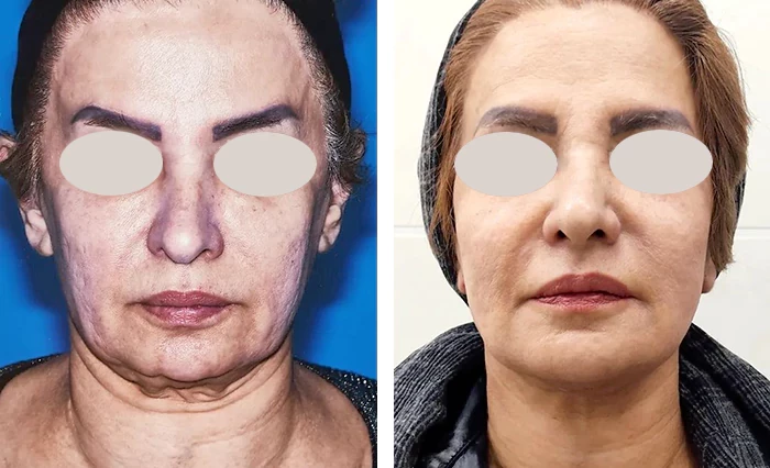 before & after photo of جراحی لیفت صورت