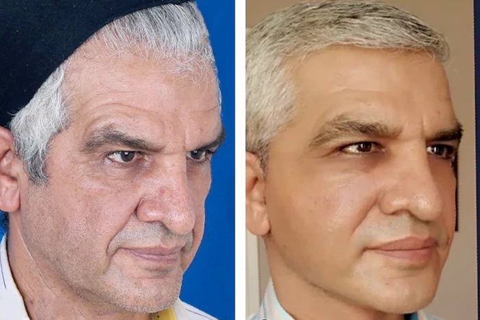 before & after photo of جراحی لیفت گردن