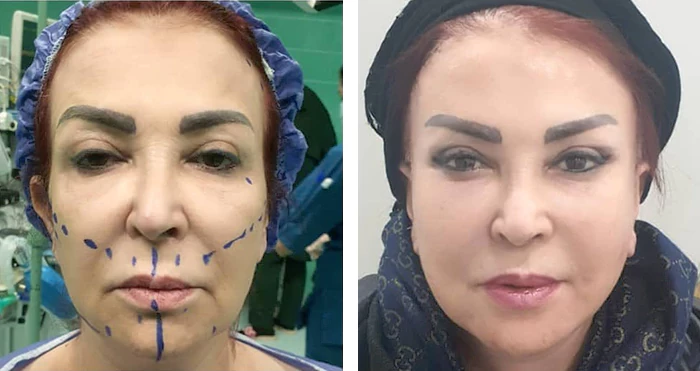 before & after photo of جراحی لیفت صورت