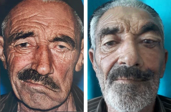 before & after photo of جراحی چانه و فک