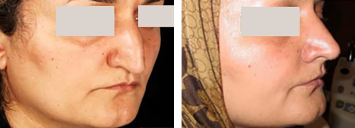 before & after photo of عمل زیبایی بینی