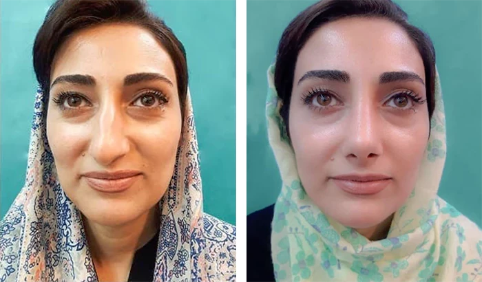 before & after photo of عمل زیبایی بینی