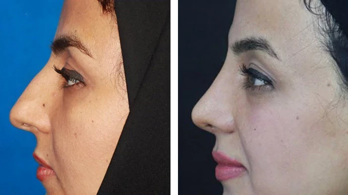 before & after photo of عمل زیبایی بینی