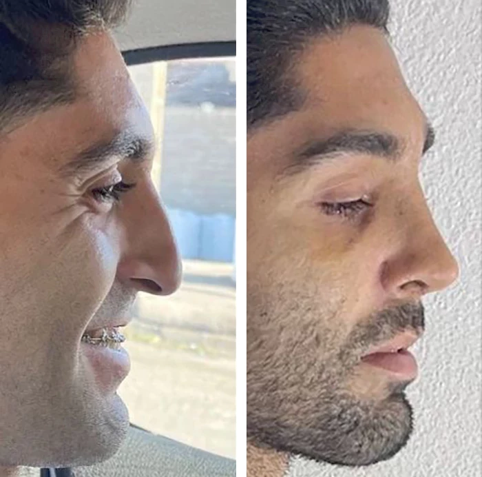 before & after photo of عمل زیبایی بینی