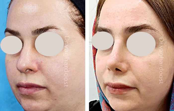 before & after photo of جراحی لیفت صورت