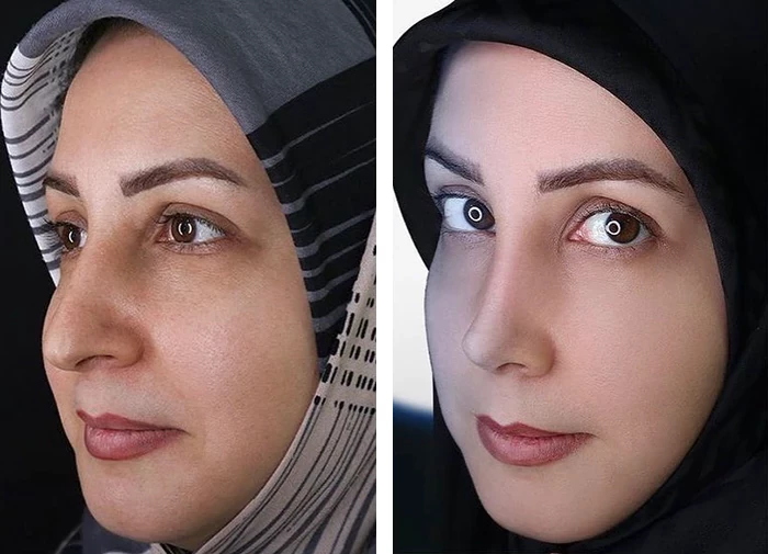 before & after photo of عمل زیبایی بینی