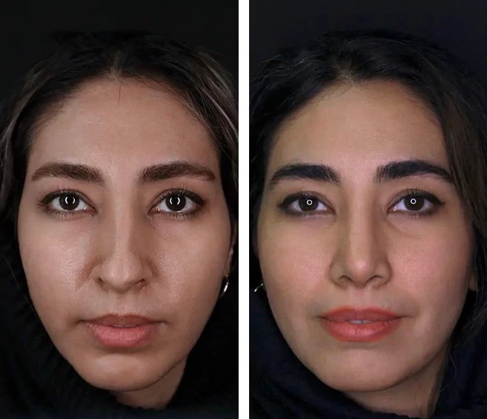 before & after photo of عمل زیبایی بینی