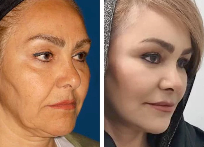 before & after photo of جراحی لیفت گردن