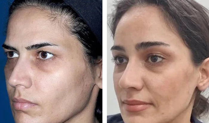 before & after photo of عمل زیبایی بینی