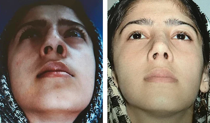 before & after photo of عمل زیبایی بینی