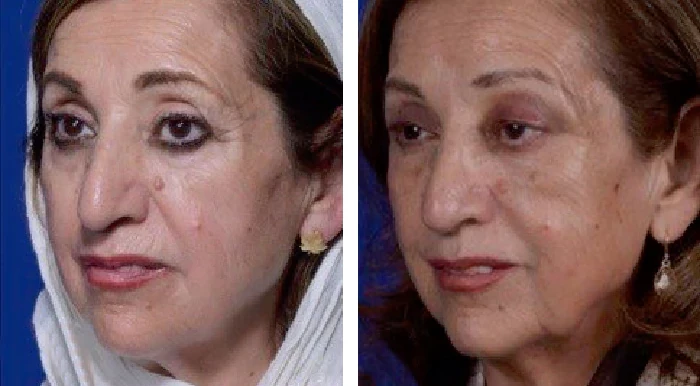 before & after photo of بلفاروپلاستی (جراحی پلک)