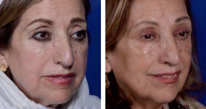 before & after photo of عمل زیبایی بینی