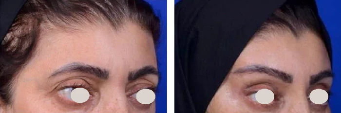 before & after photo of جراحی لیفت مستقیم ابرو