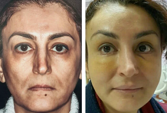 before & after photo of جراحی لیفت صورت