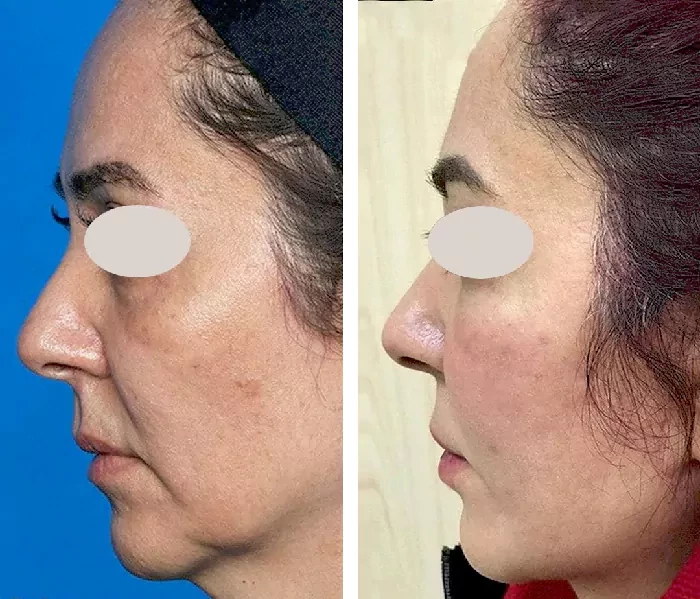 before & after photo of جراحی لیفت صورت