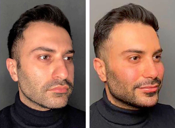 before & after photo of عمل زیبایی بینی