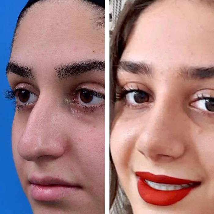 before & after photo of عمل زیبایی بینی