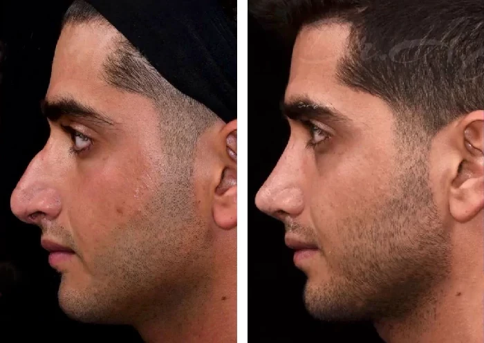 before & after photo of عمل زیبایی بینی