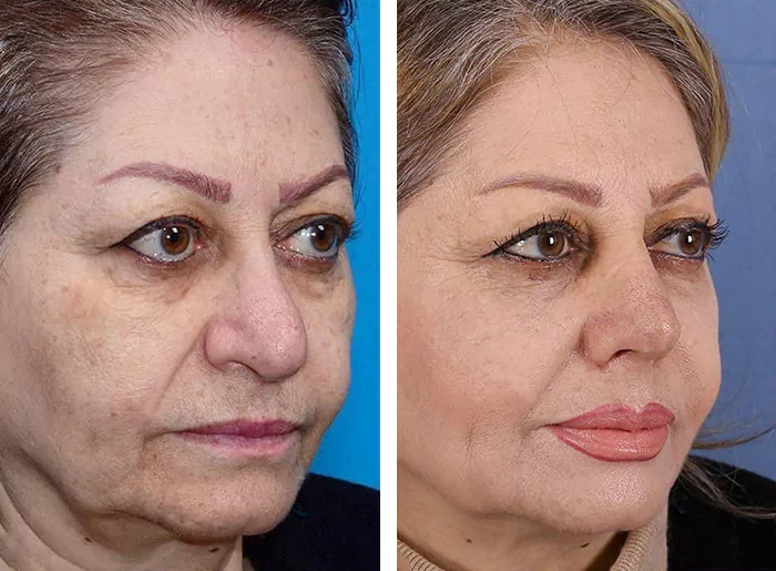 before & after photo of عمل زیبایی بینی